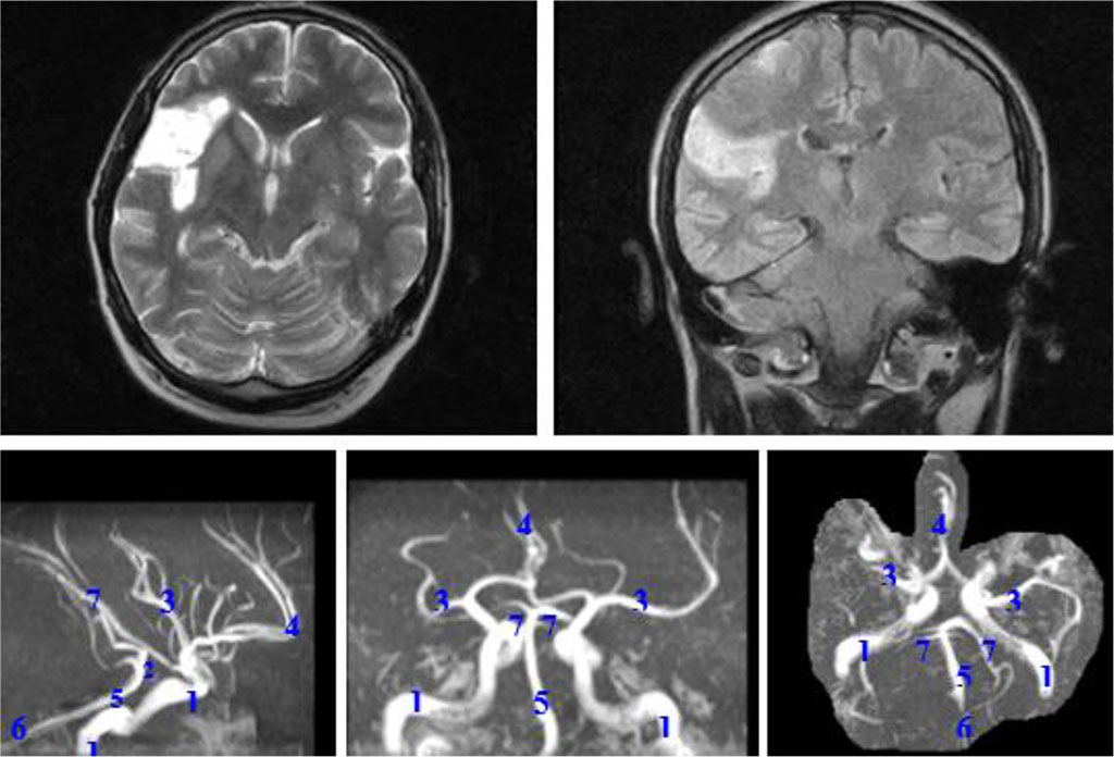 Figure 1. MRI: postischemic changes in the right hemisphere. Magnetic resonance angiography: posterior trifurcation of the right internal carotid artery, hypoplasia of both posterior communicating arteries. 1 - internal carotid arteries; 2 - posterior communicating arteries; 3 - middle cerebral arteries; 4 - anterior cerebral artery; 5 - basilar artery; 6 - vertebral arteries; 7 - posterior cerebral arteries.