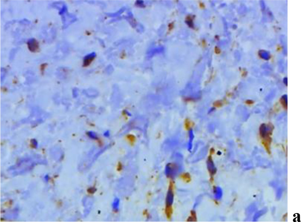 Figure 10. Immunohistochemical staining with antibodies to MMP-2(a), MMP-8(b), MMP-9 (c) in the gum biopsy material in children with inflammatory periodontal pathology and mild UCTD; ×500 (chromogen − DAB, Mayer hematoxylin counterstaining).