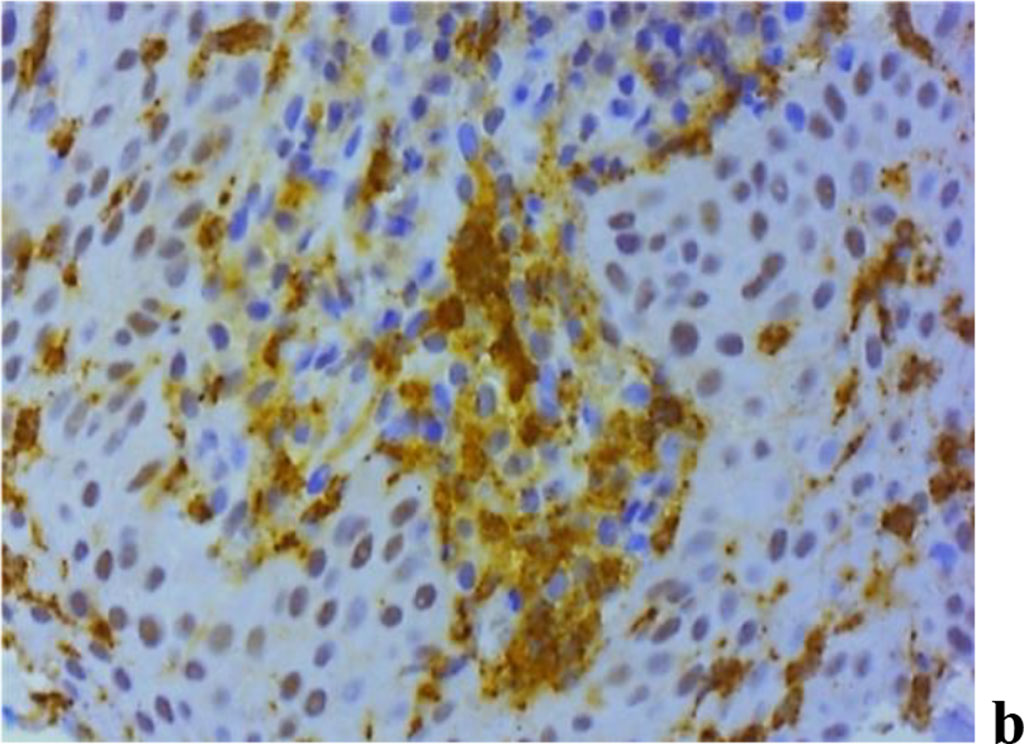 Figure 11. Immunohistochemical staining with antibodies to MMP-2(a), MMP-8(b), MMP-9 (c) in the gum biopsy material obtained from children with inflammatory periodontal pathology and mild UCTD; ×500 (chromogen − DAB, Mayer hematoxylin counterstaining).
