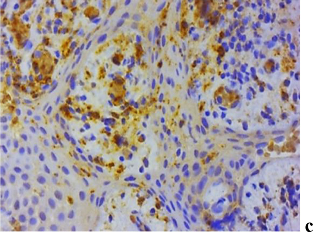 Figure 11. Immunohistochemical staining with antibodies to MMP-2(a), MMP-8(b), MMP-9 (c) in the gum biopsy material obtained from children with inflammatory periodontal pathology and mild UCTD; ×500 (chromogen − DAB, Mayer hematoxylin counterstaining).