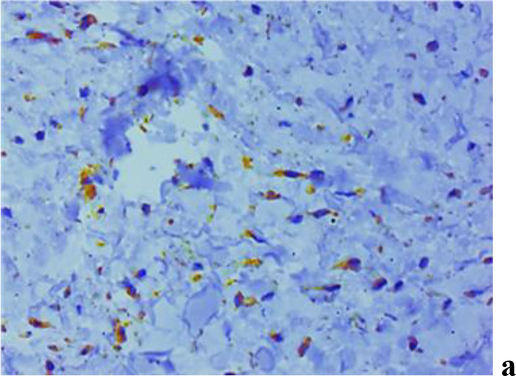 Figure 9. Immunohistochemical staining with antibodies to MMP-2(a), MMP-8(b), MMP-9 (c) in gum biopsy material in children with intact periodontium with no clinical symptoms of UCTD; ×500 (chromogen − DAB, Mayer hematoxylin counterstaining).