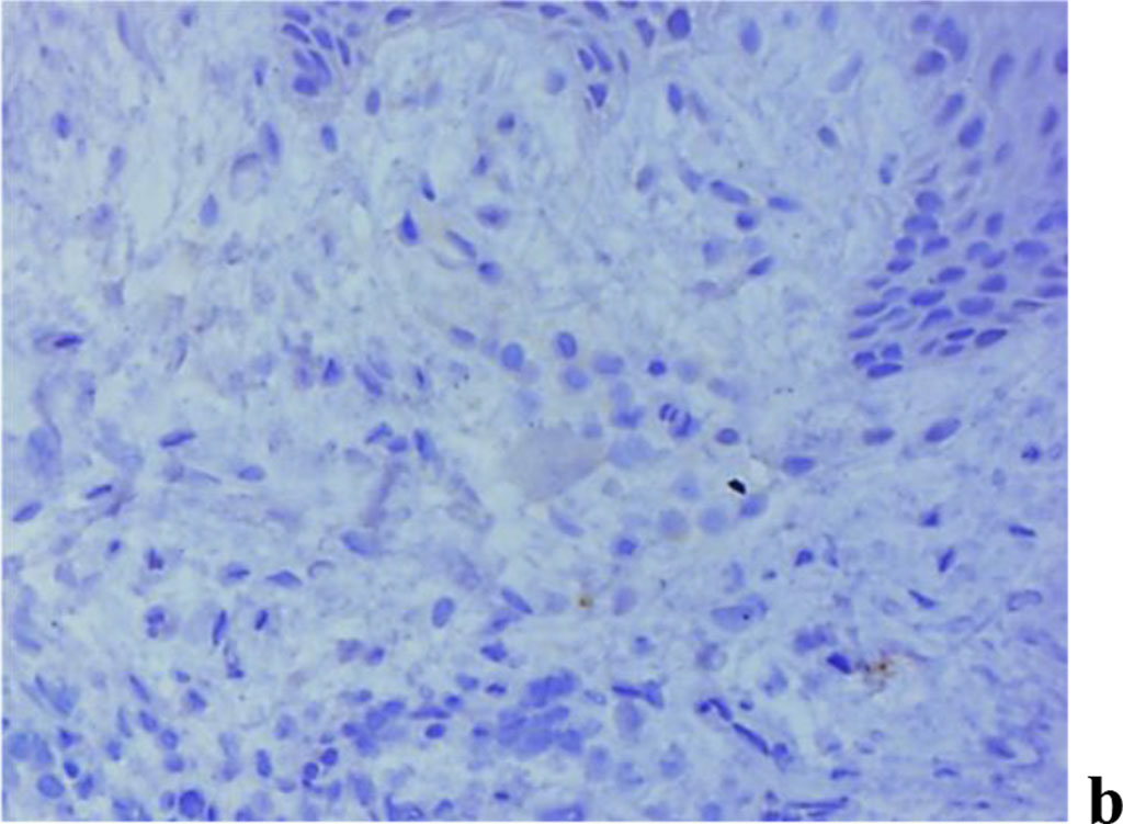 Figure 9. Immunohistochemical staining with antibodies to MMP-2(a), MMP-8(b), MMP-9 (c) in gum biopsy material in children with intact periodontium with no clinical symptoms of UCTD; ×500 (chromogen − DAB, Mayer hematoxylin counterstaining).