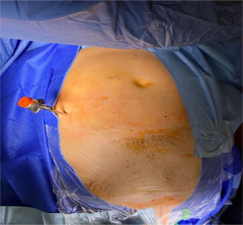 Figure 2 Access to pneumoperitoneum at the Palmer's point with a Veress needle (3 cm below the left costal arch in the mid-clavicular line). /Source: Author Content/