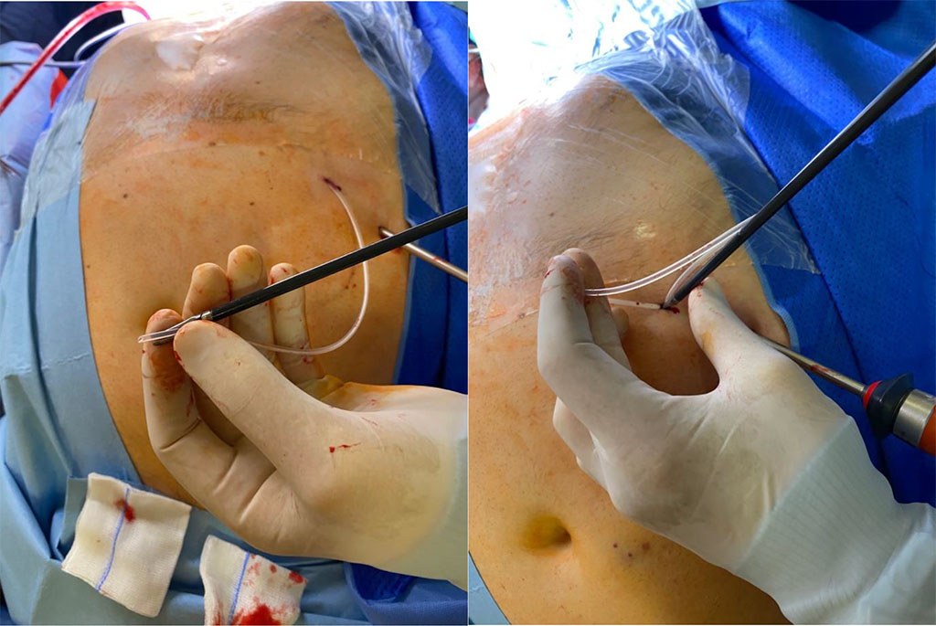 Figure 3 The drain was placed in the dissector arms and inserted through the abdominal wall into the peritoneal cavity under camera control in direct visualization. /Source: Author Content/