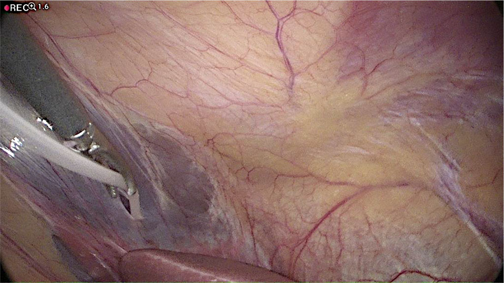 Figure 5 Catheter is passing through the hole in the falciform ligament. /Source: Author Content/