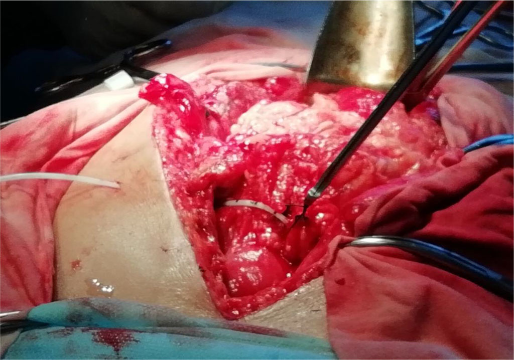 Figure 1 Fixation of the catheter in the lumen of the right gastroepiploic vein with the Roeder’s knot using a pusher (knot pusher)
