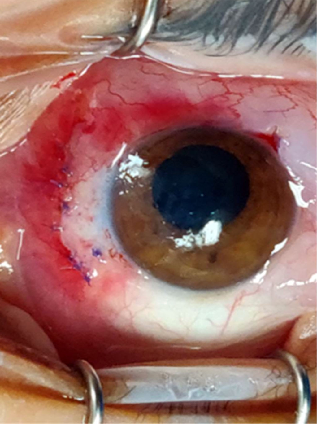 Fig. 4B Fixation of conjunctival flap to nasal sclera with Vicryl sutures. 
Both techniques had complete closure of wounds in the supra limbal area.