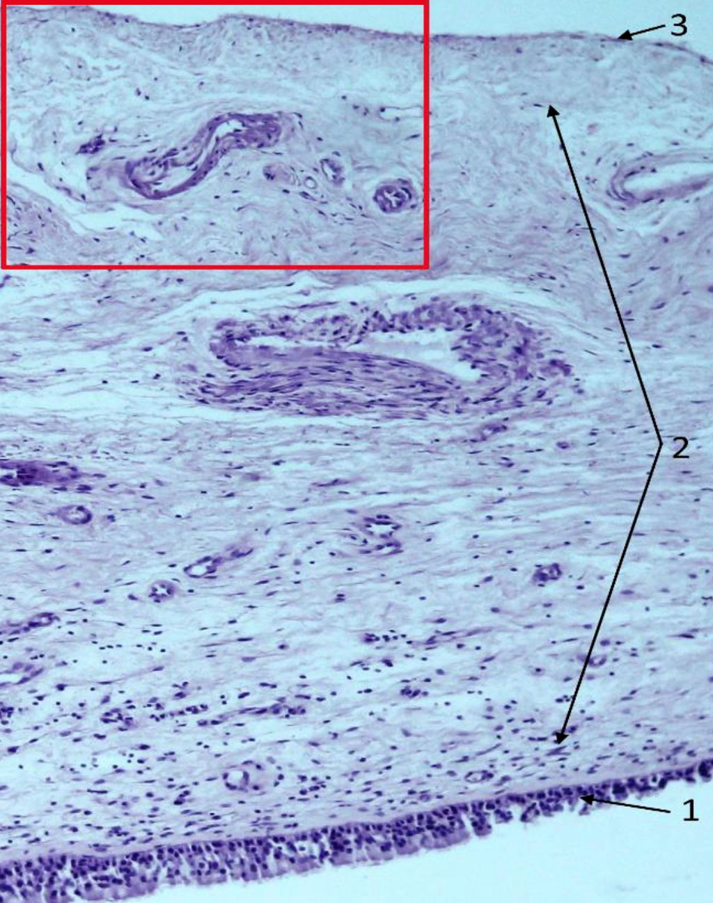 Fig. 1. Section of the Schneiderian membrane from the anterior wall of the maxillary sinus of a 49-year-old man. Staining by using hematoxylin and eosin. Magnification 100X. 1- epithelium; 2- loose connective tissue of the lamina propria; 3-periosteum.