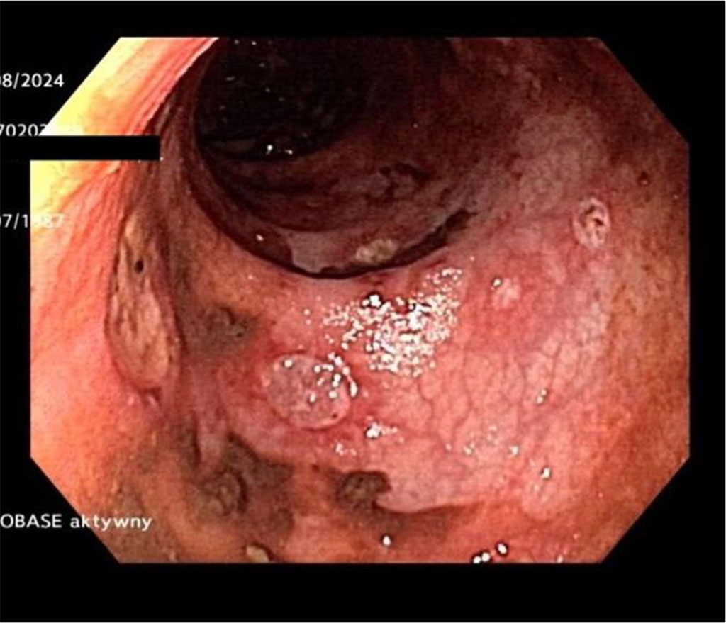Investigative Gastroscopy showing 1-2 mm rectal ulcers with the bases covered in fibrin.