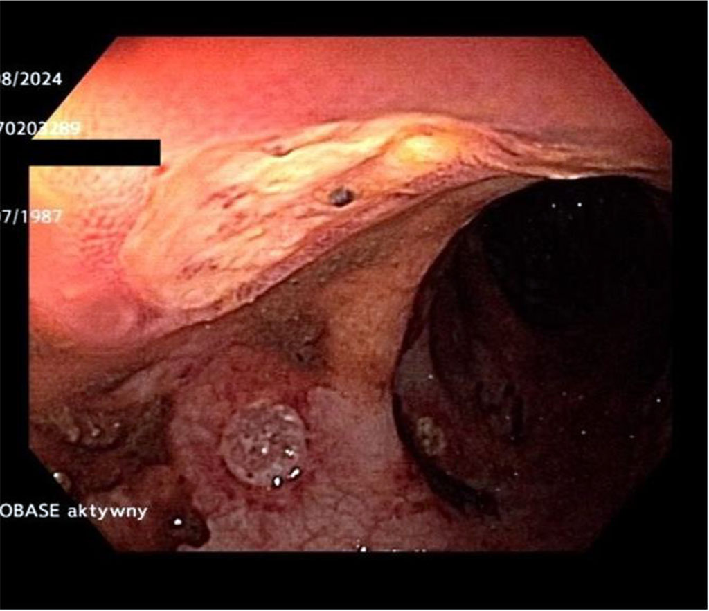 Investigative Gastroscopy showing 1-2 mm rectal ulcers with the bases covered in fibrin.