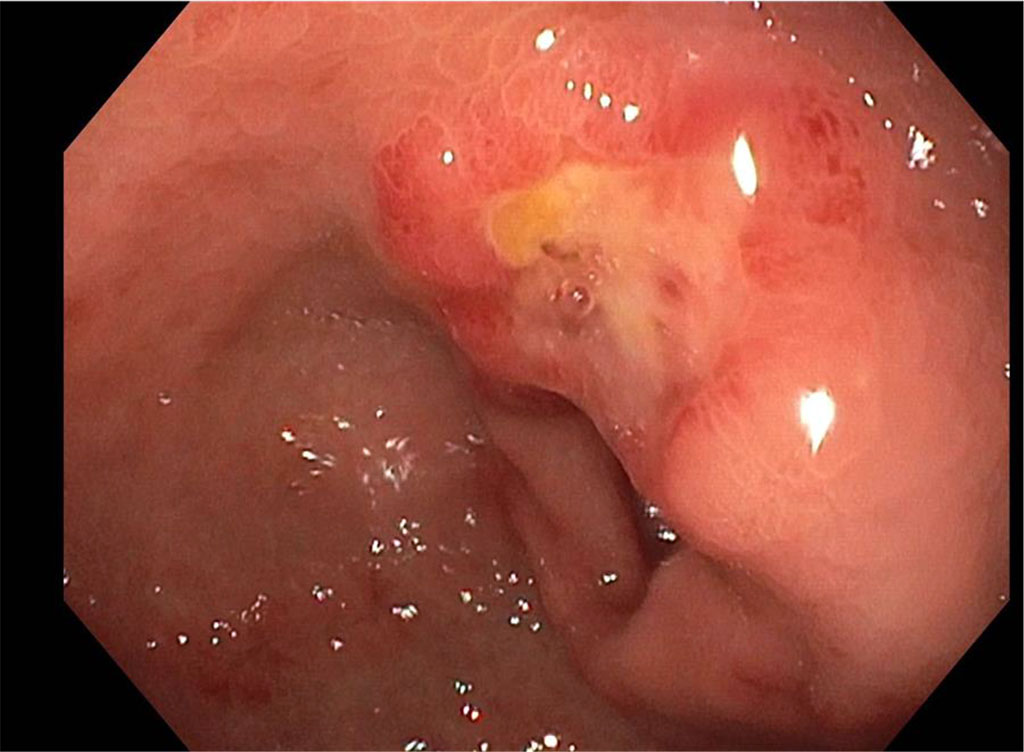 Figure 3. Further Gastroscopy findings showed deviations in the Antrum around the lesser curvature of the Pylorus, including a flat ulcer with a fibrinous base.