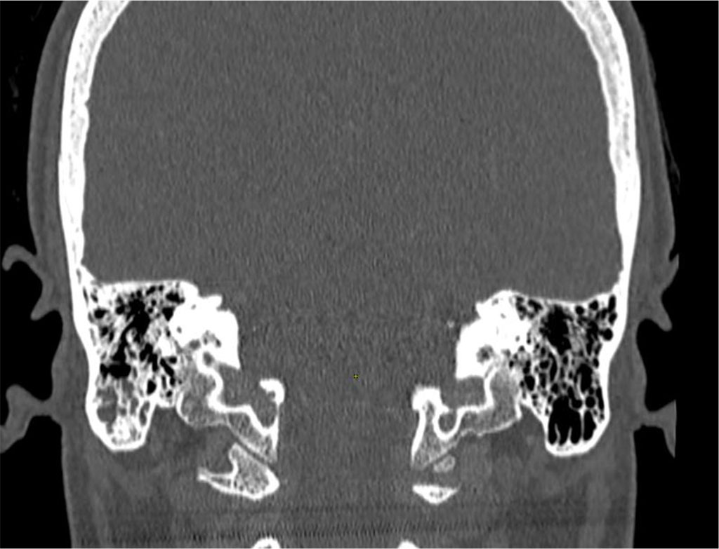 Figure 4. Signs of left ear congestion alongside slightly asymmetrical hearing