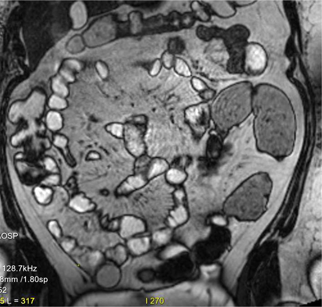 Figure 5. Segmental enhancement (up to about 2 cm long), of the mucosa in 3-4 locations in the ileum. The changes widespread and accompanied by subtle edema of the submucosal layer.