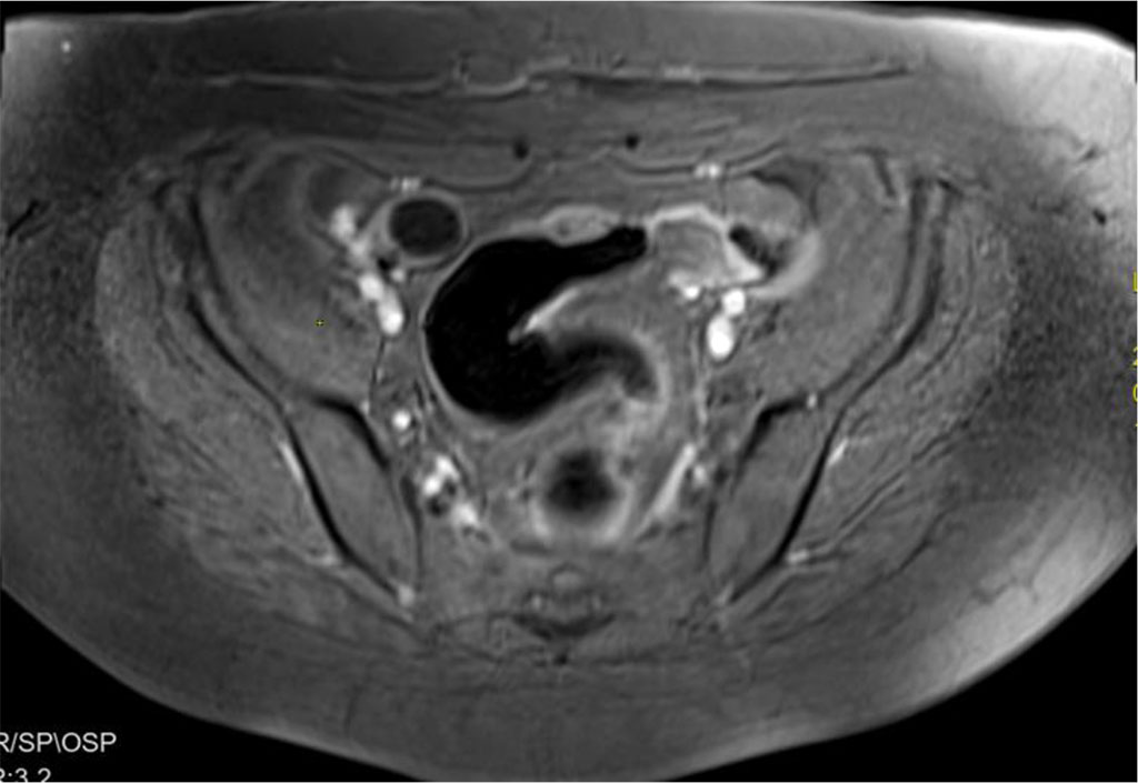 Figure 6. Suspicion of an endometriosis focus