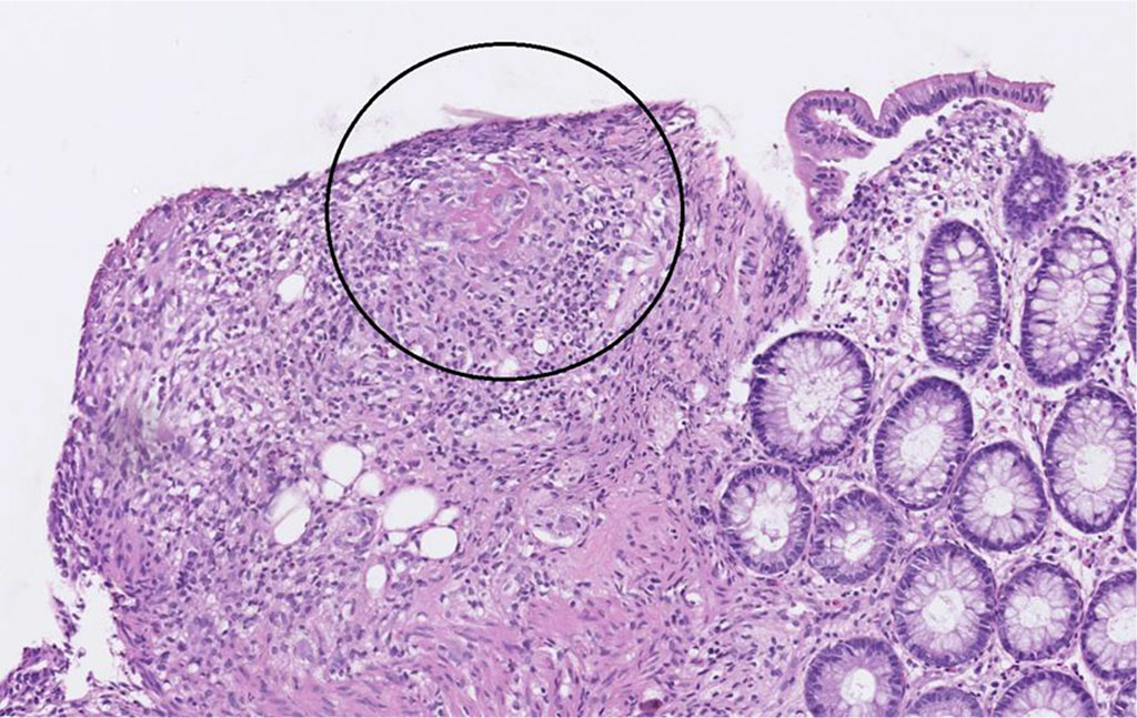 Figure 7 Discrete change in the submucosa that could be a granuloma with centralized fibrinoid necrosis.

