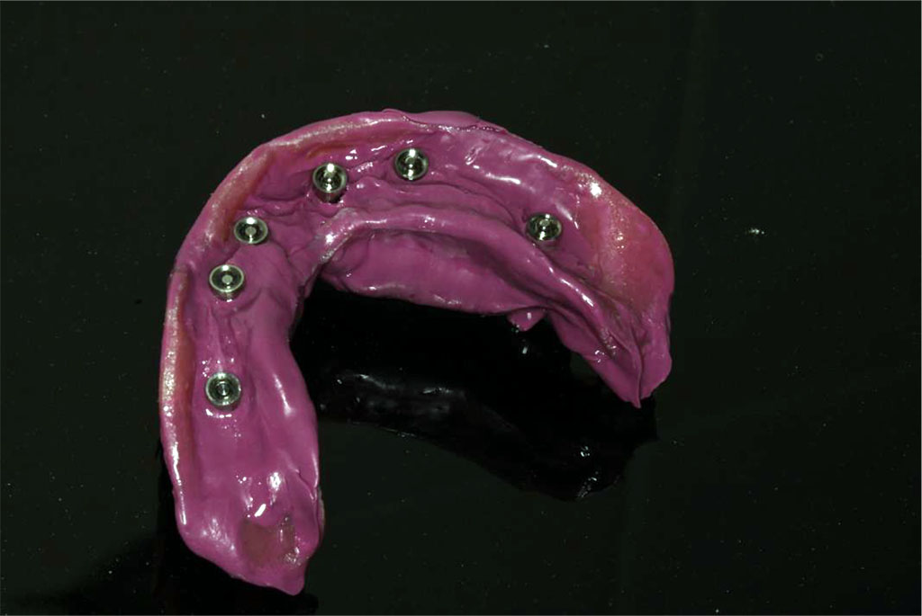 Figure 1. Representative images of a conventional dental impressions. Image courtesy of the author.