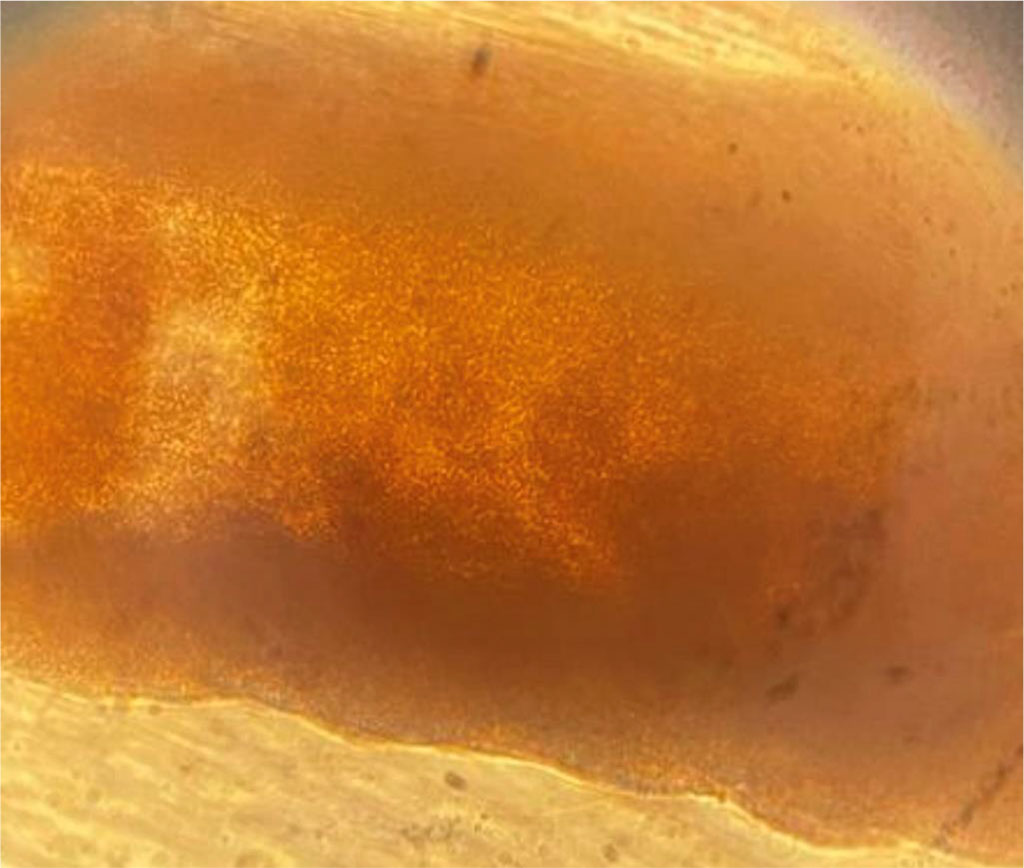 Fig. 3 Direct microscopy of hair affected by black piedra (× 400)