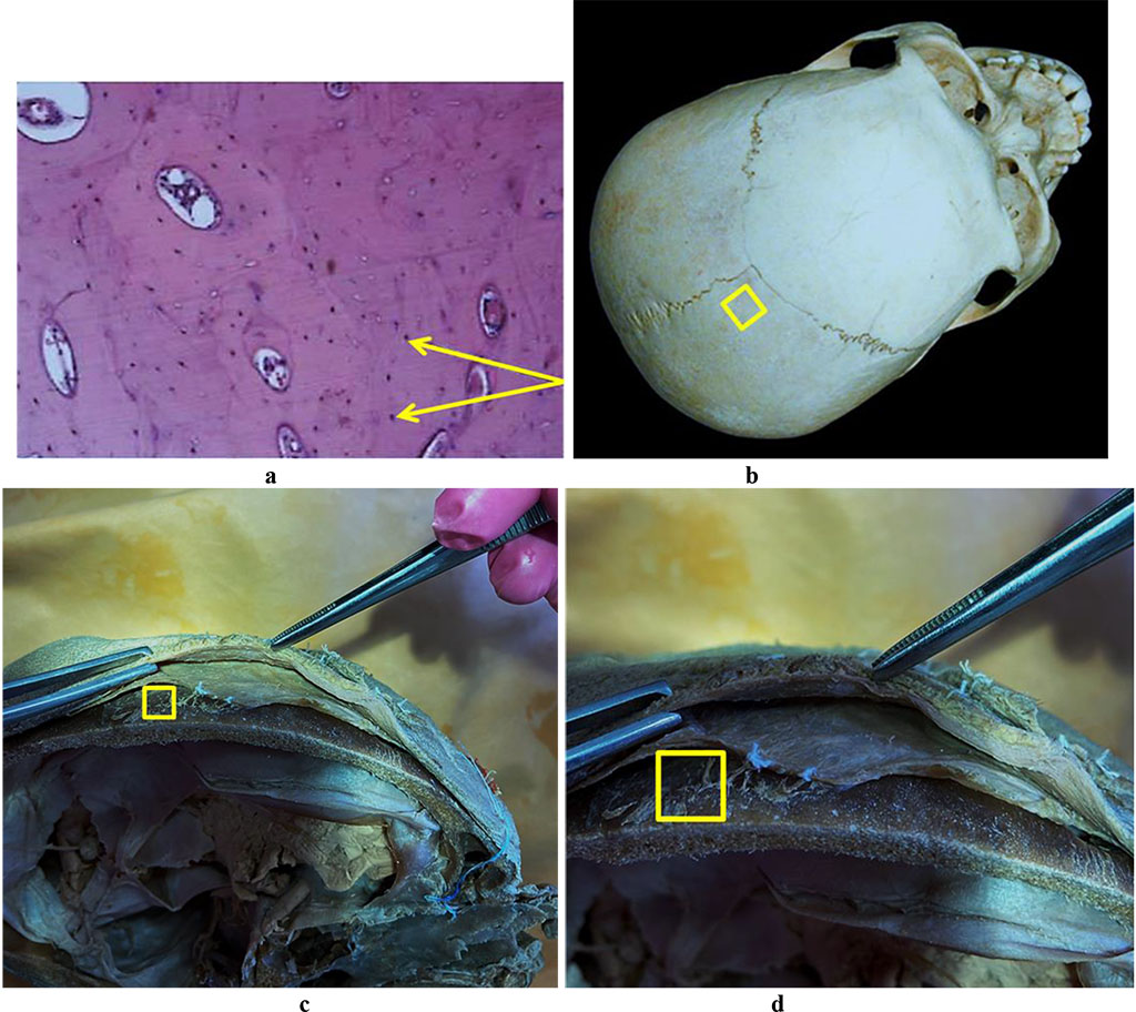Figure 7. Bone biopsy from the parietal area: a – histological preparation of intact bone from the parietal area (×400, hematoxylin-eosin staining, osteocytes indicated by an arrow); b – a section of the donor zone done to obtain an autograft from the parietal area; c, d – an anatomical preparation after the fasciocutaneous flap detachment.