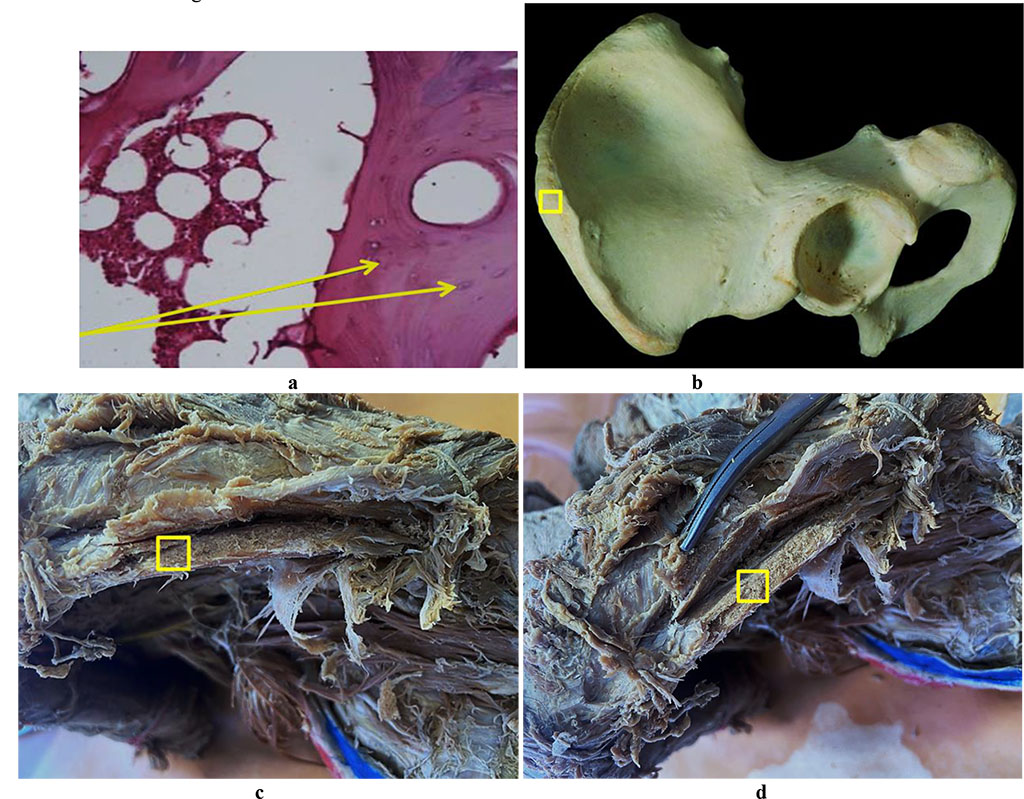 Figure 8. Bone biopsy from the iliac crest area: a – histological preparation of intact bone from the iliac crest area (×400, hematoxylin-eosin staining, osteocytes indicated by an arrow); b – a donor zone section to take an autograft from the iliac crest area; c, d – an anatomical preparation after the fasciocutaneous flap detachment.