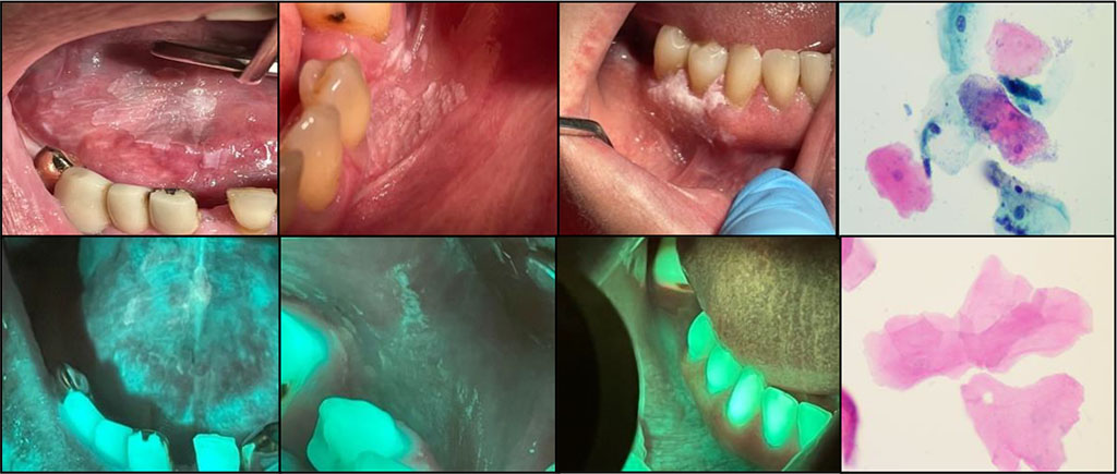Fig 3a The phenomena of OM hyperkeratosis