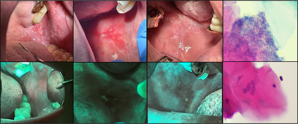 Fig 4a Inflammatory processes of the oral mucosa 
