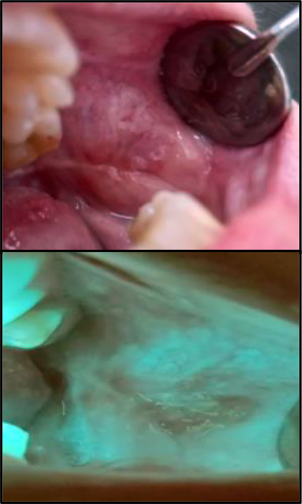Fig 5a Buccal mucosa malignant neoplasm of the left cheek 