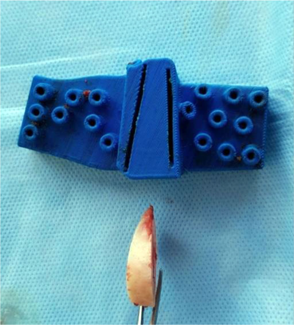 Figure 5. Appearance of the INS and bone wedge of the femur after resection