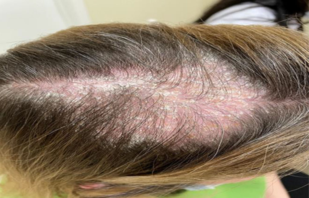Fig. 1 Manifestations of follicular lichen planus in the frontal-parietal 