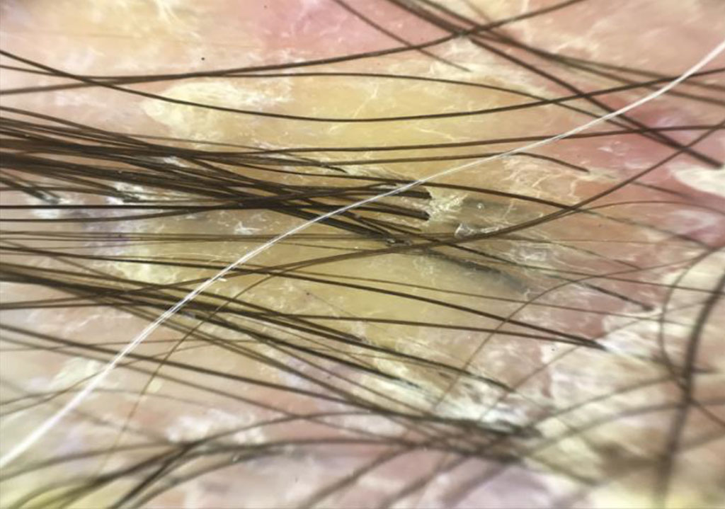 Fig. 1a Trichoscopy of follicular lichen planus: yellowish thick scales covering several hairs