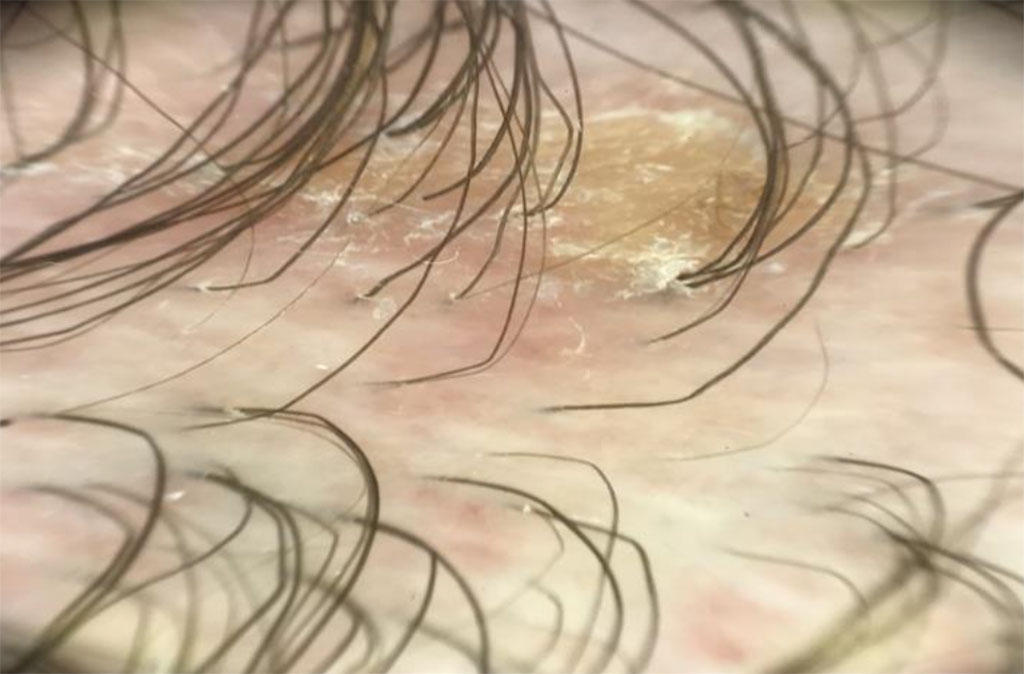 Fig. 1b Trichoscopy of follicular lichen planus: erythema, follicular hyperkeratosis, milky red areas of fibrosis