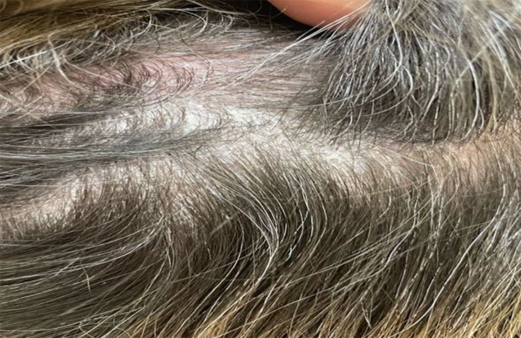 Fig. 2 Psoriatic rashes in the occipital region