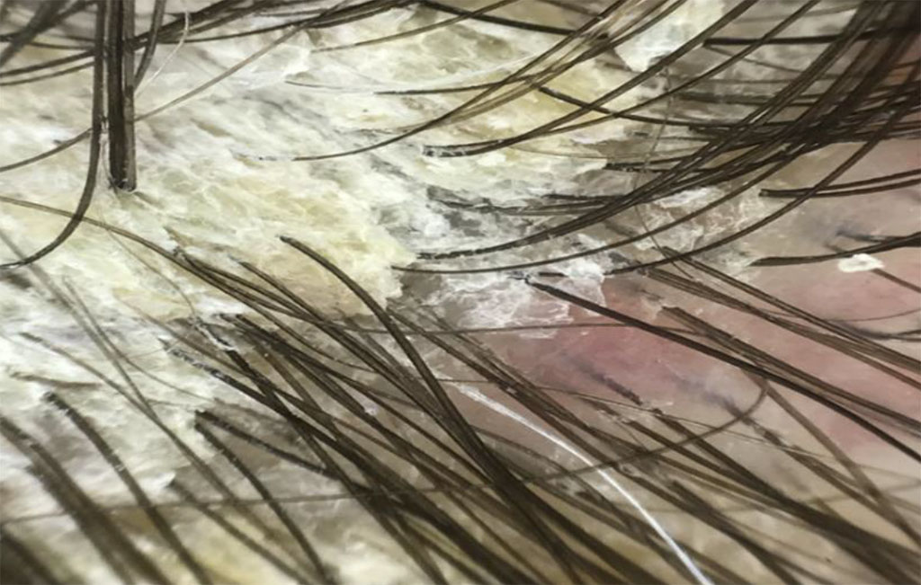 Fig. 2a Trichoscopy of psoriasis: layered silvery-white scales