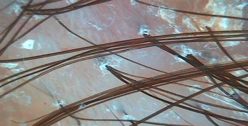 Fig. 2b Trichoscopy of psoriasis: twisted capillary loops, milky-red areas of fibrosis