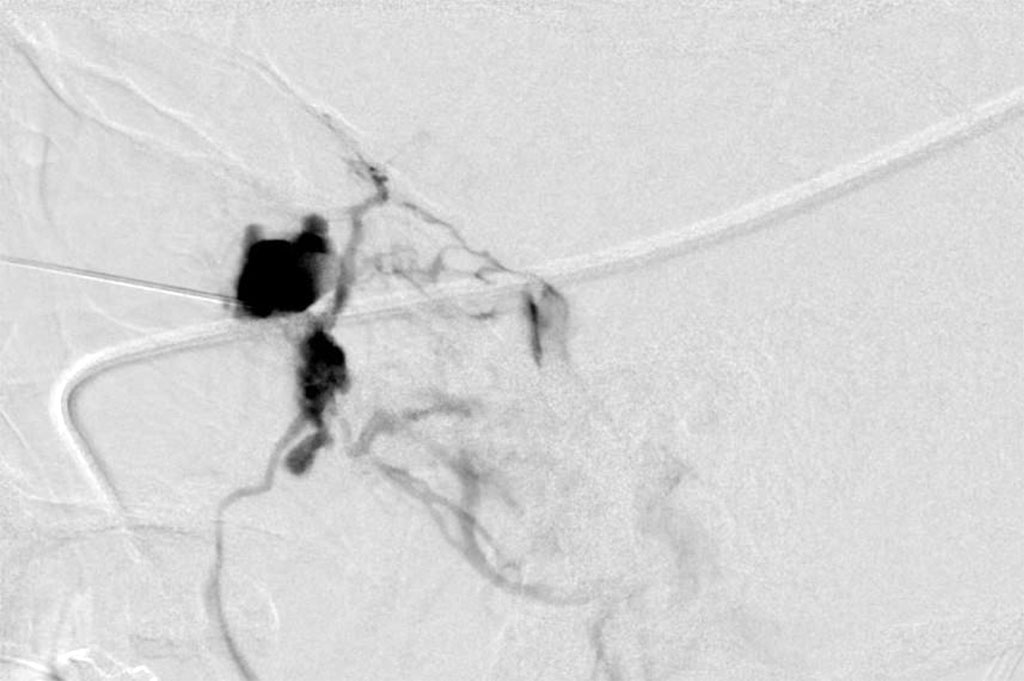 Figure 3: Sclerotherapy – showing sclerosing agent in the vessels of the lesion 