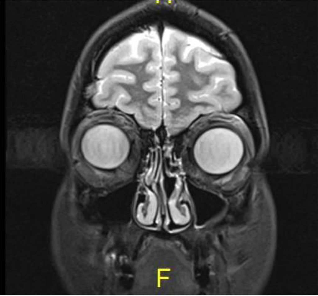 Figure 4c: Coronal MR T2: Complete resolution of lesion