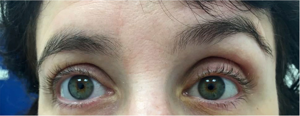 Figure 5: Clinical photo post sclerotherapy demonstrating left hypoglobus 