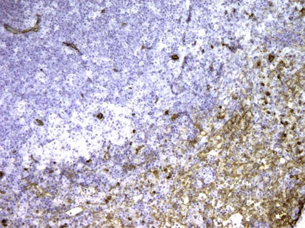 Figure 2. Rat lymph node. Picture on the 3rd day of intralymphatic administration of APG. The appearance of Bcl-2+ cell expression around the “light centers”. X100