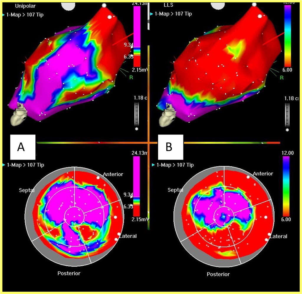 Fig. 1. Unipolar voltage and mechanical maps of the left ventricle
