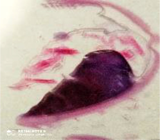 Figure 1. Macroscopic picture of human eye melanoma with a trapezoidal shape. Eye section after enucleation stained with hematoxylin and eosin. The dimensions of the eyeball correspond to the actual dimensions after fixation in neutral formalin.