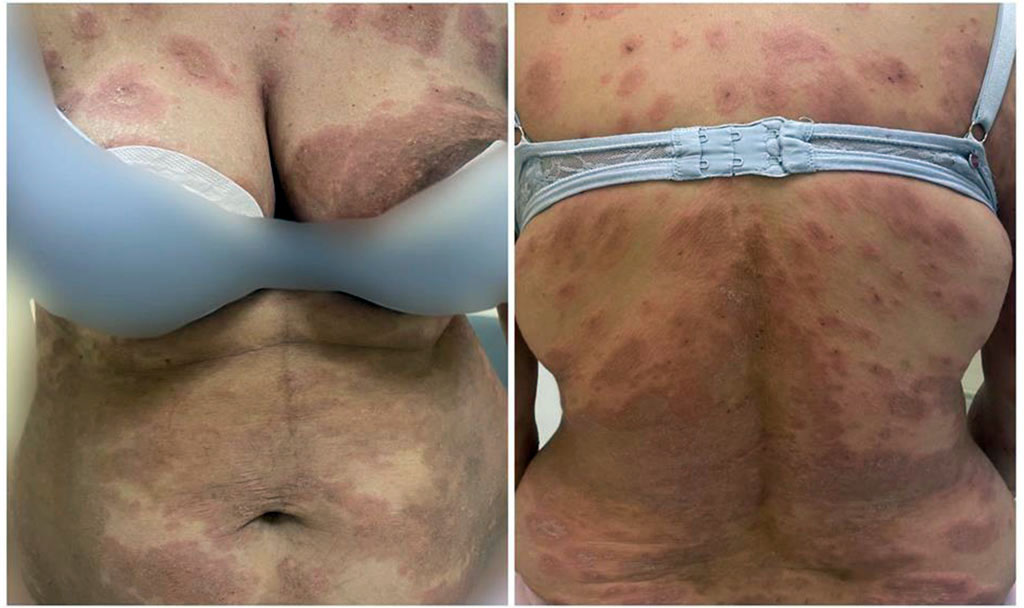Fig 1. Patient P., 37 years old. Erythematous rash on the skin of the trunk