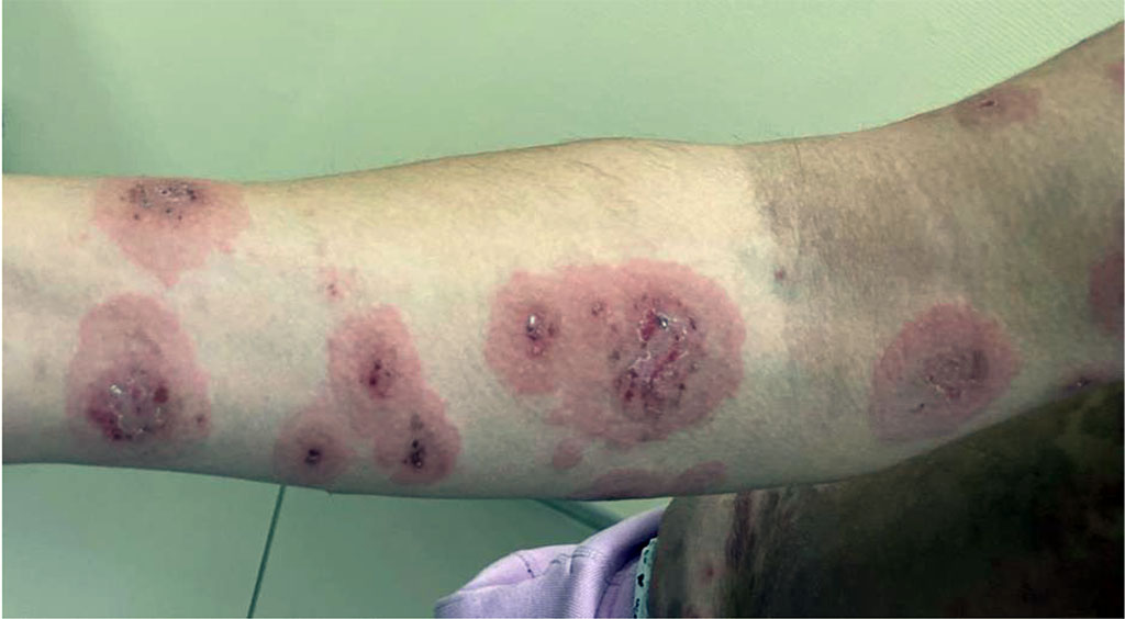 Fig. 2. Patient P., 37 years old. Target-like erythematous rashes. Grouped erosions and crusts on the surface of erythema.