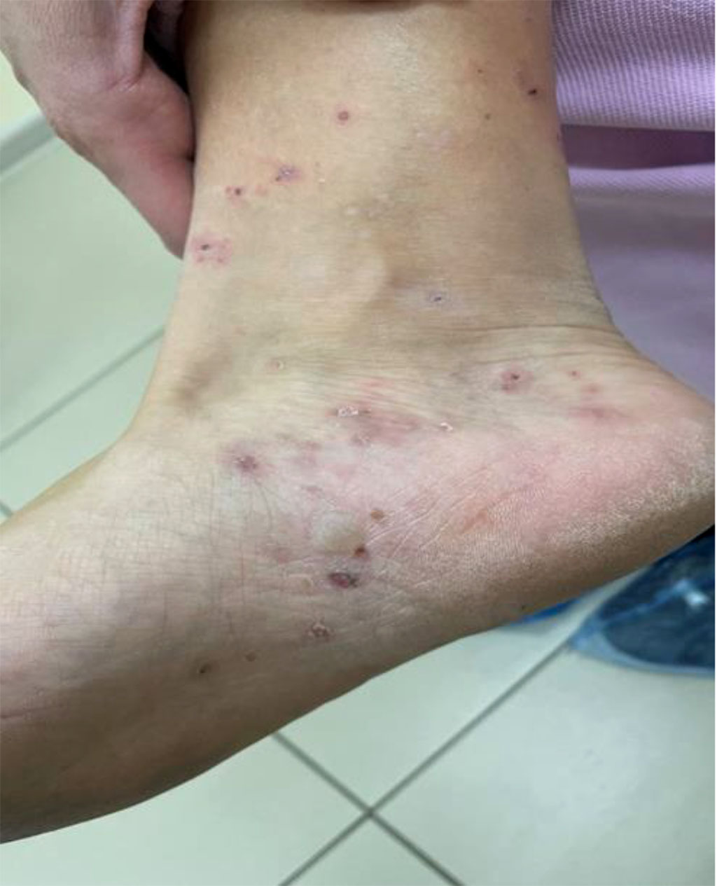 Fig.3 Patient P., 37 years old. Blistering rashes on the background of erythema. Multiple excoriations on the skin in the ankle joint and arch of the foot.