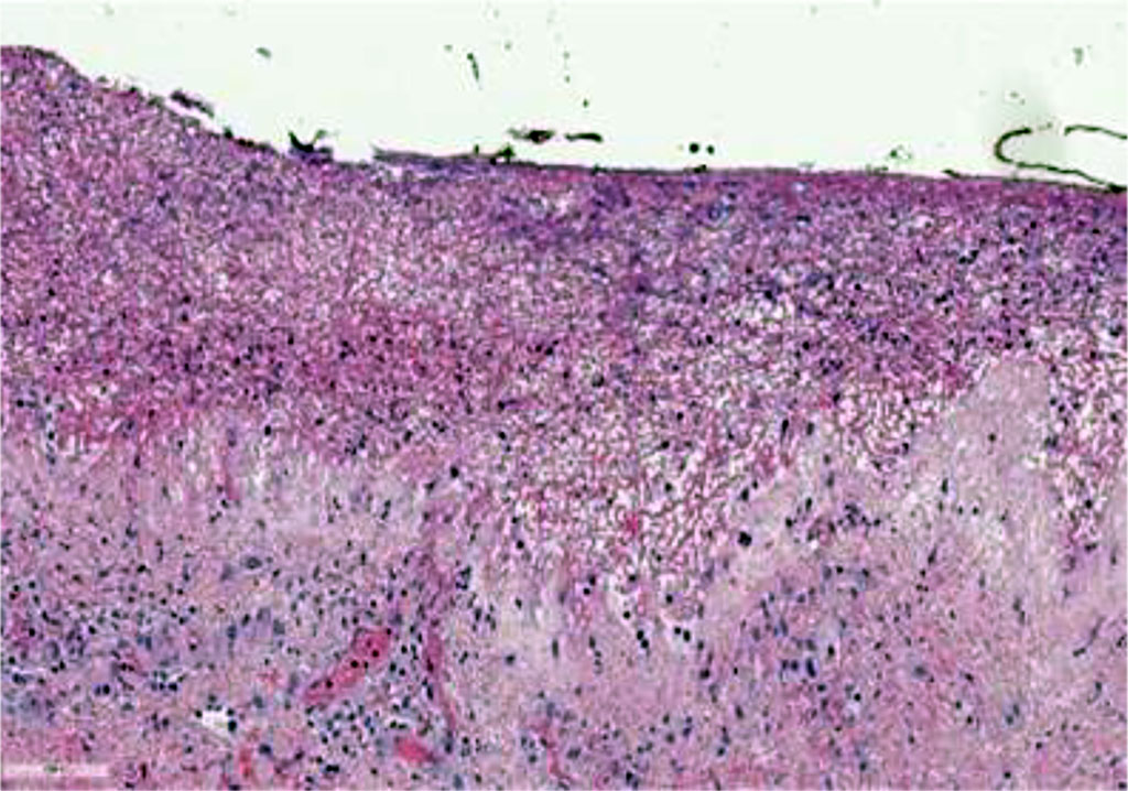 Fig. 4. Histological picture of bullous pemphigoid in pregnancy, hematoxylin and eosin staining (×75)