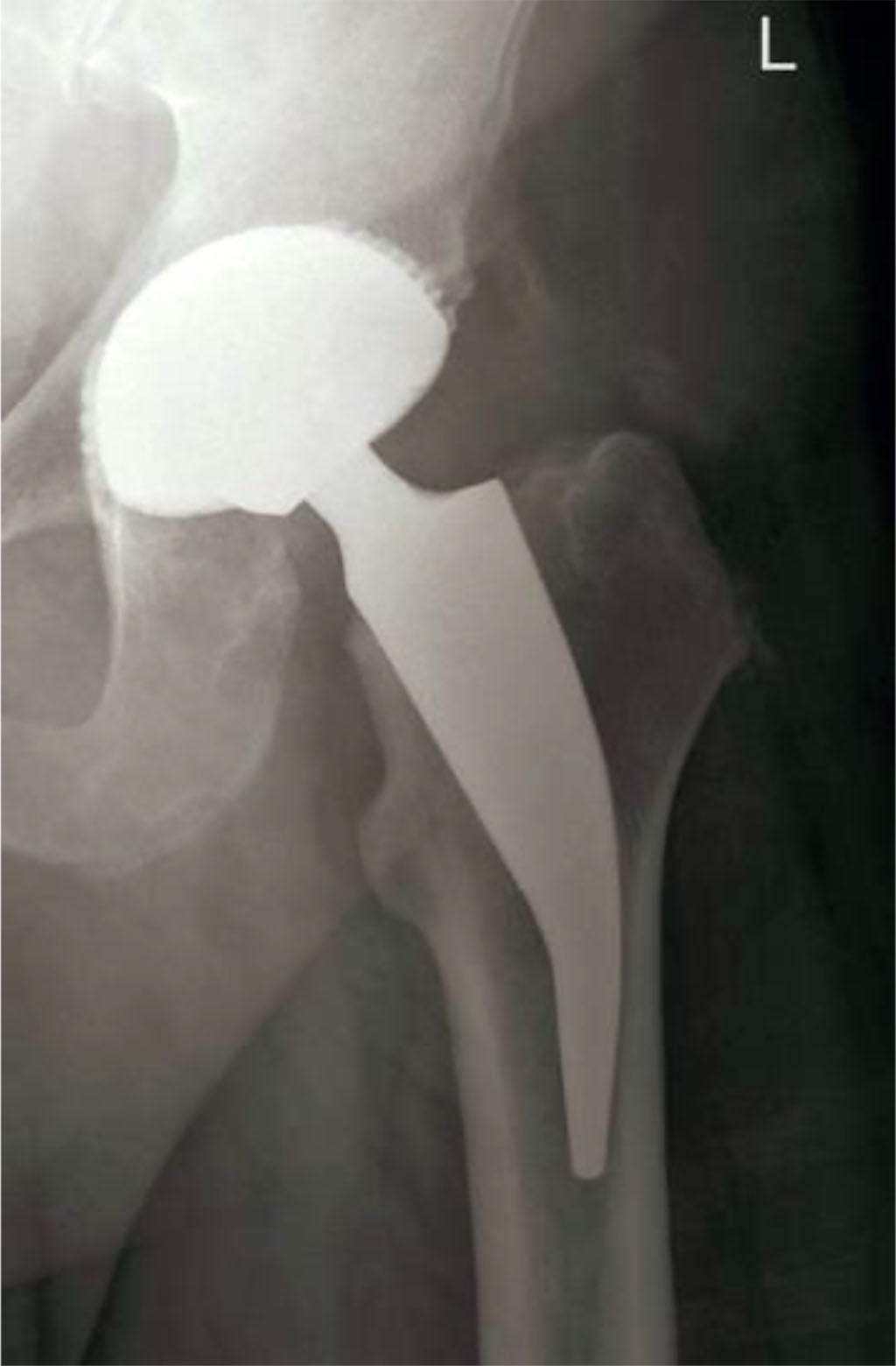 Fig 1. Radiological examination of the left hip joint after the surgery – THA [44].