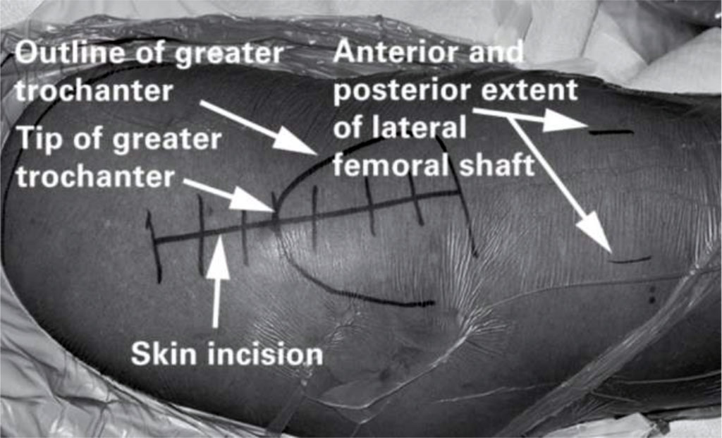 Fig 4. The skin incision used for the direct lateral approach to the hip [43].