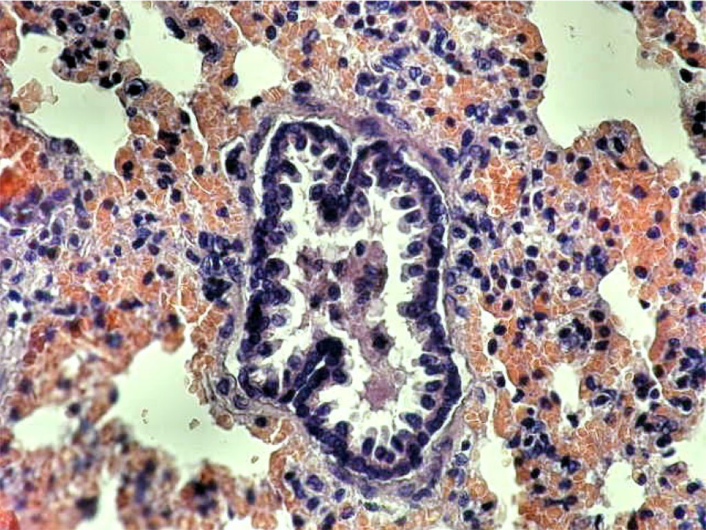 Figure 1. Rat lung. 24 hours after baclofen administration. Intraalveolar hemorrhages, WBC infiltration of intraalveolar septa, desquamation of epithelium in the lumen of the bronchioli 