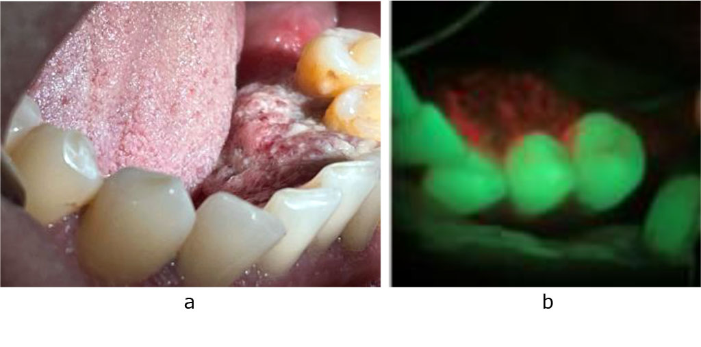 Fig. 3. a - squamous cell carcinoma of the floor of the mouth b - optical image of squamous cell carcinoma of the floor of the mouth