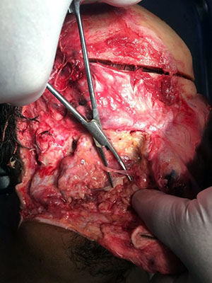 Fig. 1 Selected fragment of the parotid duct