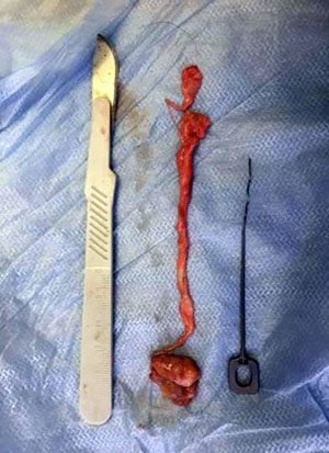 Fig. 2 The removed fragment of the parotid duct