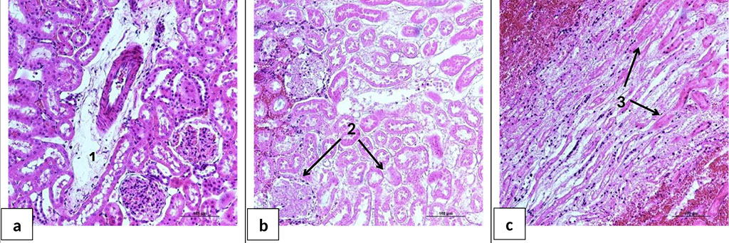 Figure 6. Microphotographs of kidney sections 24 hours after HS and reperfusion. a - the cortical layer of the kidney of the rat of the group HS+AB. b - the cortical layer of the kidney of the rat of the group HS+BES. c - the medulla of the kidney of the rat of the group HS+BES. 1 - perivascular edema; 2 - necrosis of the renal tubules and glomeruli of the cortical layer; 3 - necrosis of the epithelium of the collecting ducts of the medulla. H&E staining. Ob. ×20.